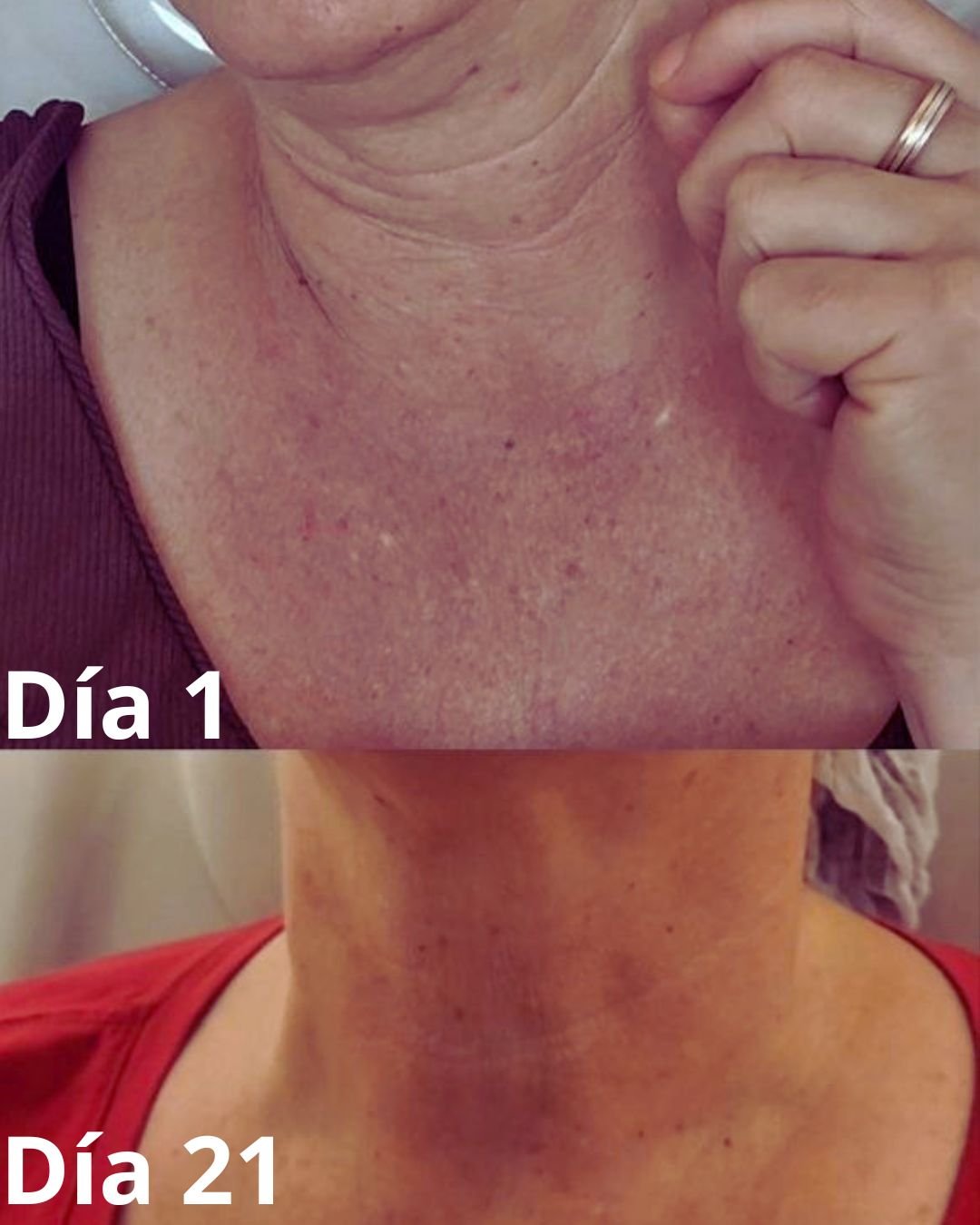Profhilo en Cuello