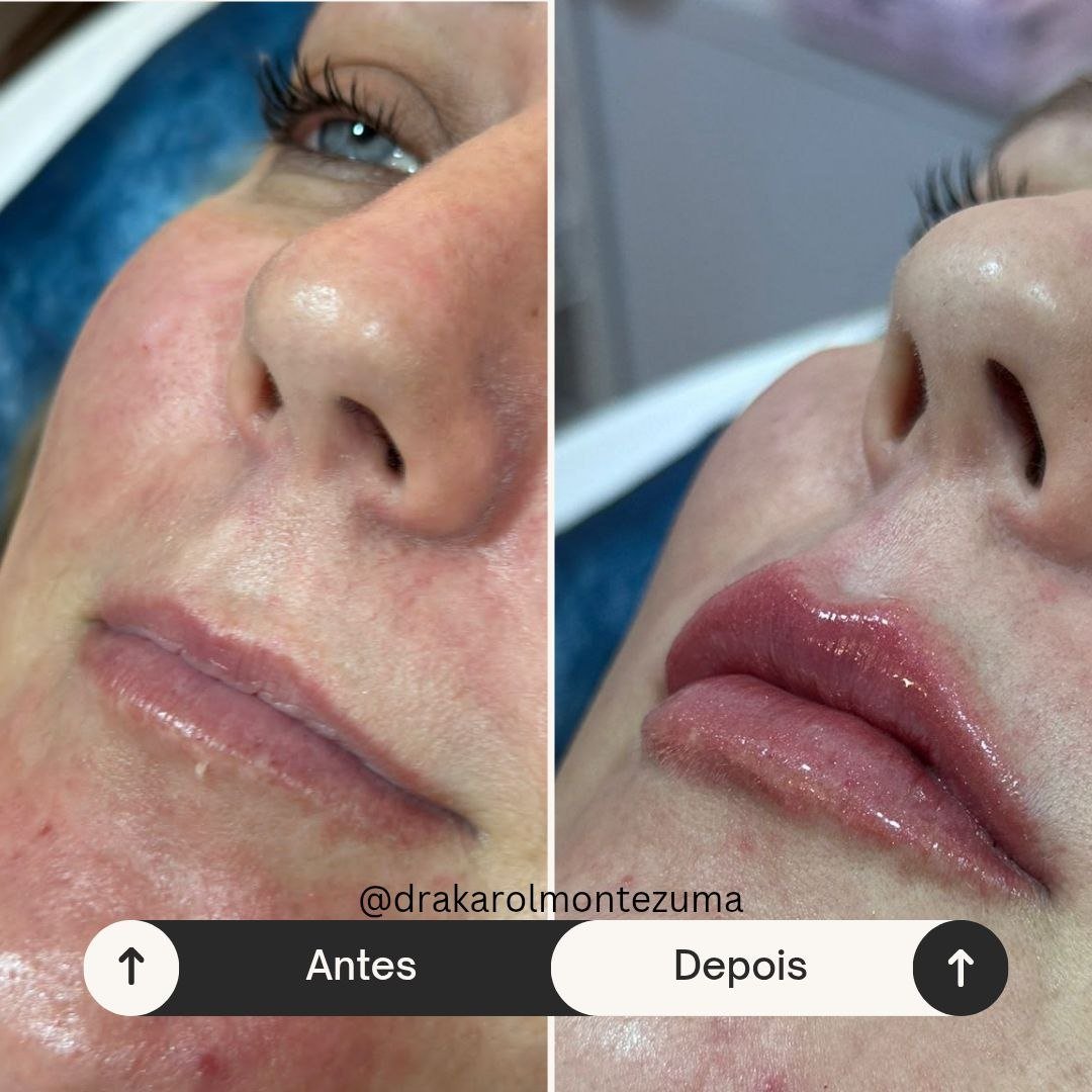 Rellenos faciales