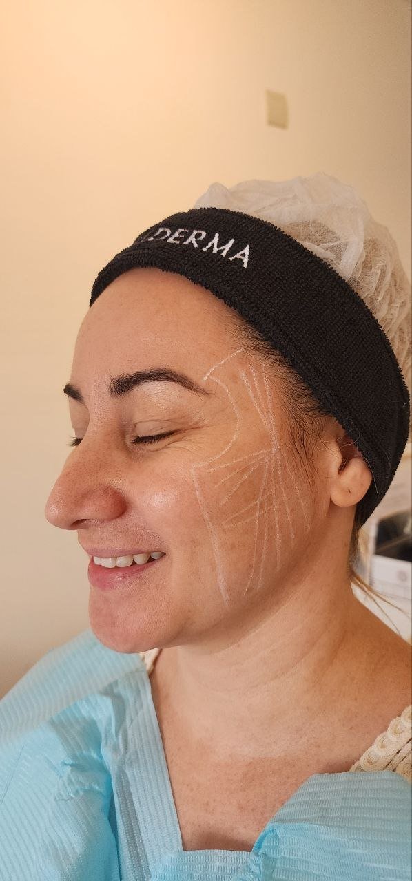 Sculptra