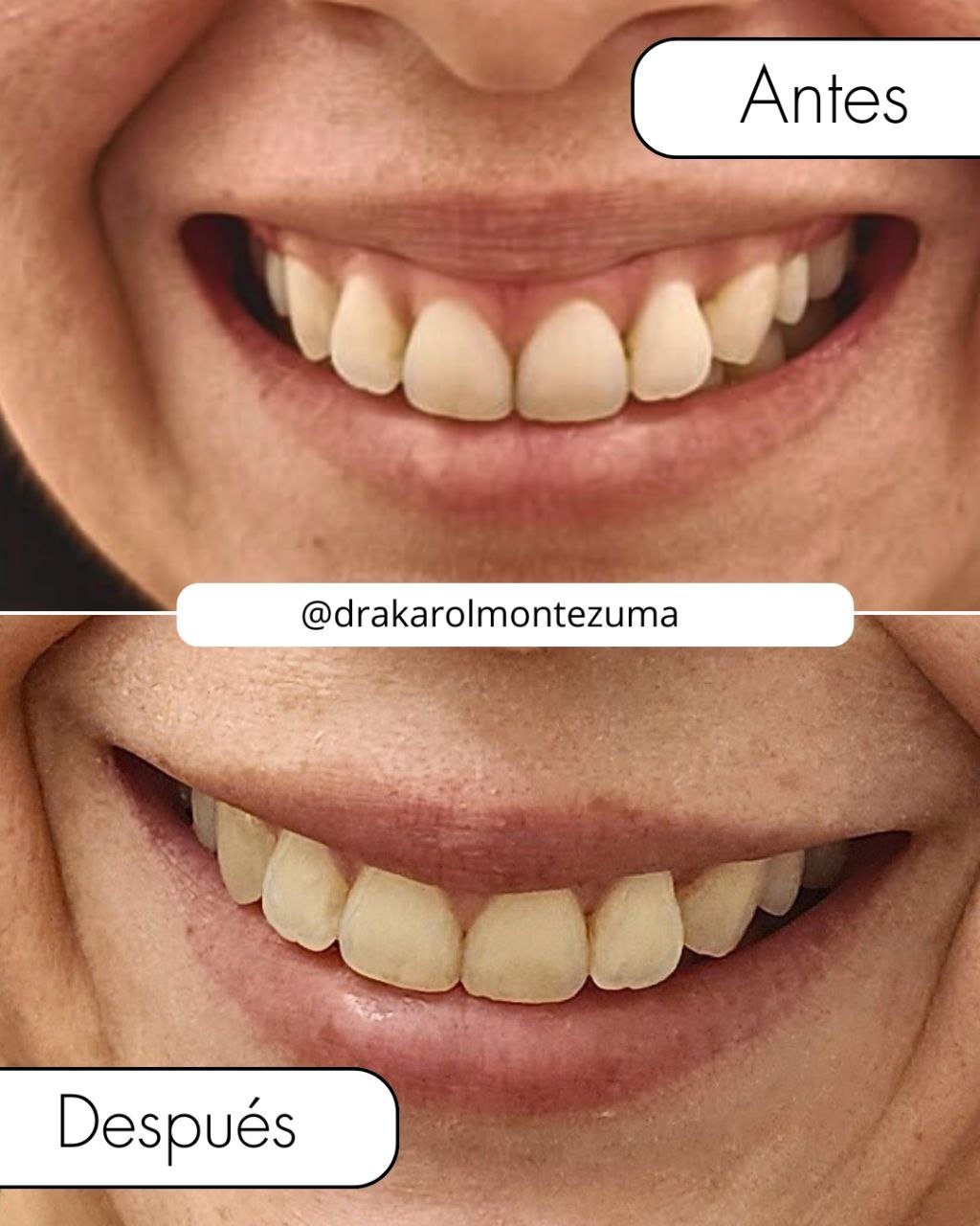 Sonrisa gingival - Toxina Botulínica