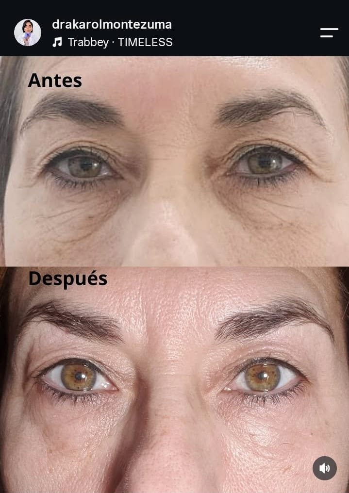 Antes y después de Plasma IQ en contorno de ojos