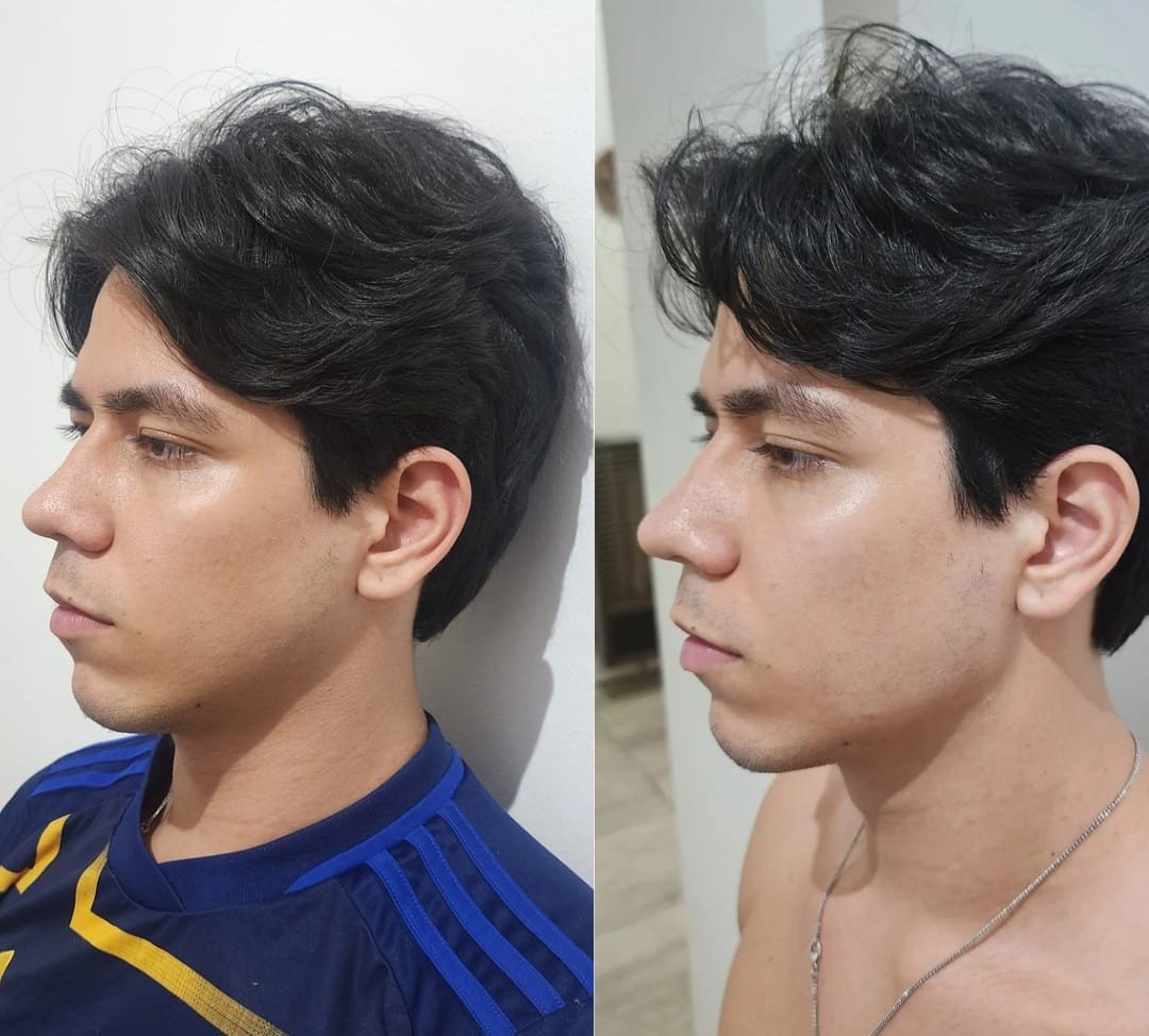 Armonización Facial