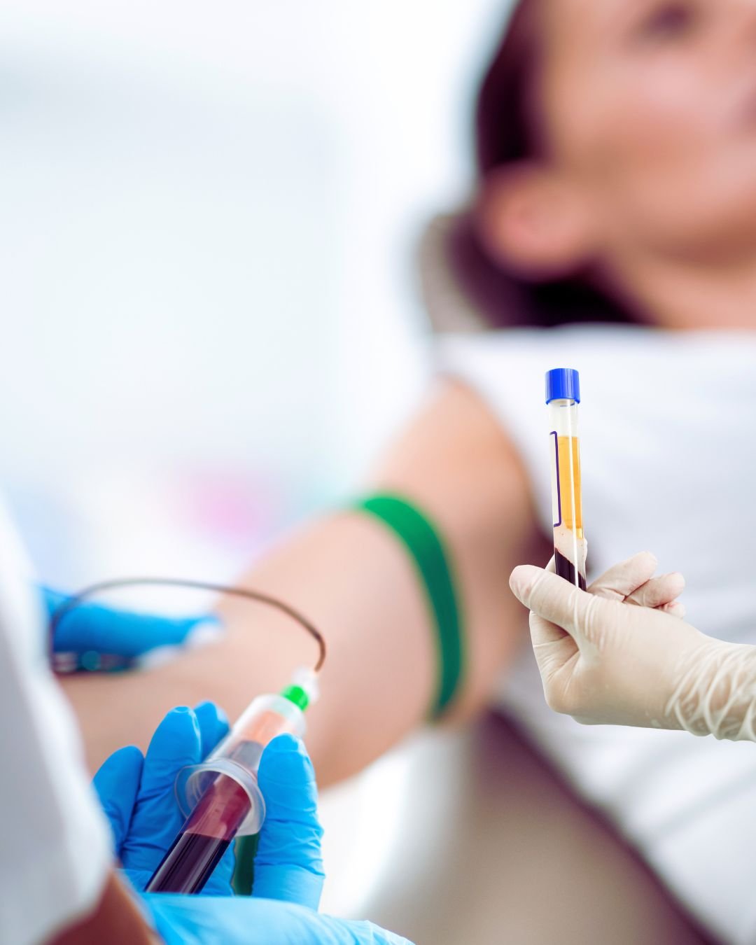 PRP y Mesoterapia