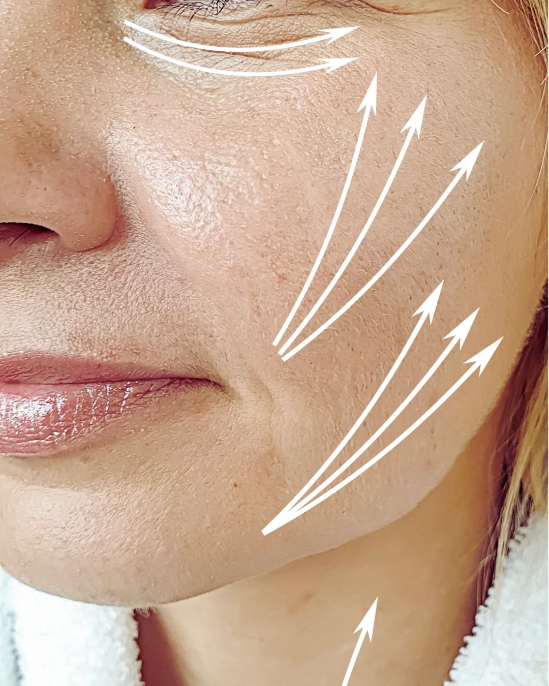 Radiesse y Sculptra